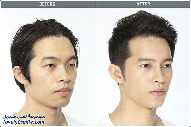 صور قبل وبعد عمليات التجميل في كوريا الجنوبية